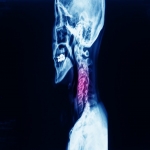 A Guide to Treatment of Cervical Radiculopathy