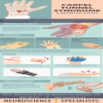 Carpal Tunnel Syndrome A Detailed Study