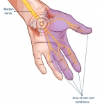 Carpal Tunnel Syndrome and the Treatments