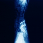 Cervical Radiculopathy - The Causes & Treatment