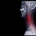 Cervical Radiculopathy Treatment: How The Process Goes?