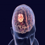 Common Facts about Brain Tumor You Must Not Miss