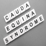 How Can You Treat Cauda Equina Syndrome?