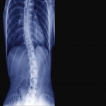 How Scoliosis Can Lead to Breath Shortness