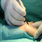 Post Recovery Period of Carpal Tunnel Surgery