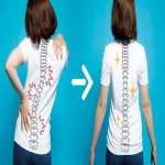 Scoliosis and Its Treatment Options