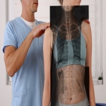 Scoliosis – Symptoms, Causes and Types