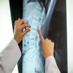 Signs You Need a Spine Surgery at Its Earliest