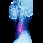 The Causes and Symptoms of Cervical Radiculopathy