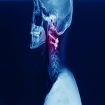 Various Nonsurgical Treatment Options for Cervical Radiculopathy
