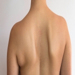 What Is Minimally Invasive Scoliosis Surgery and Its Advantages?