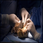 What You May Not Know About Carpal Tunnel Surgery