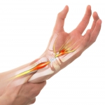 When Do You Need Carpal Tunnel Surgery?