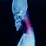 Your Guide to Cervical Radiculopathy Recovery